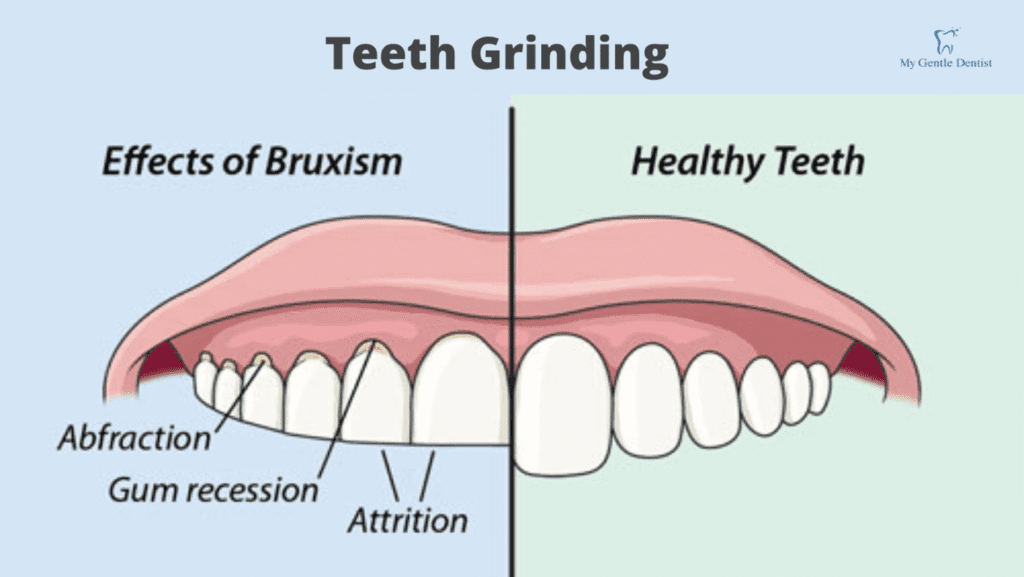 Reasons You Should Get a Night Mouth Guard to Protect Your Teeth Reasons You Should Get a Night Mouth Guard to Protect Your Teeth