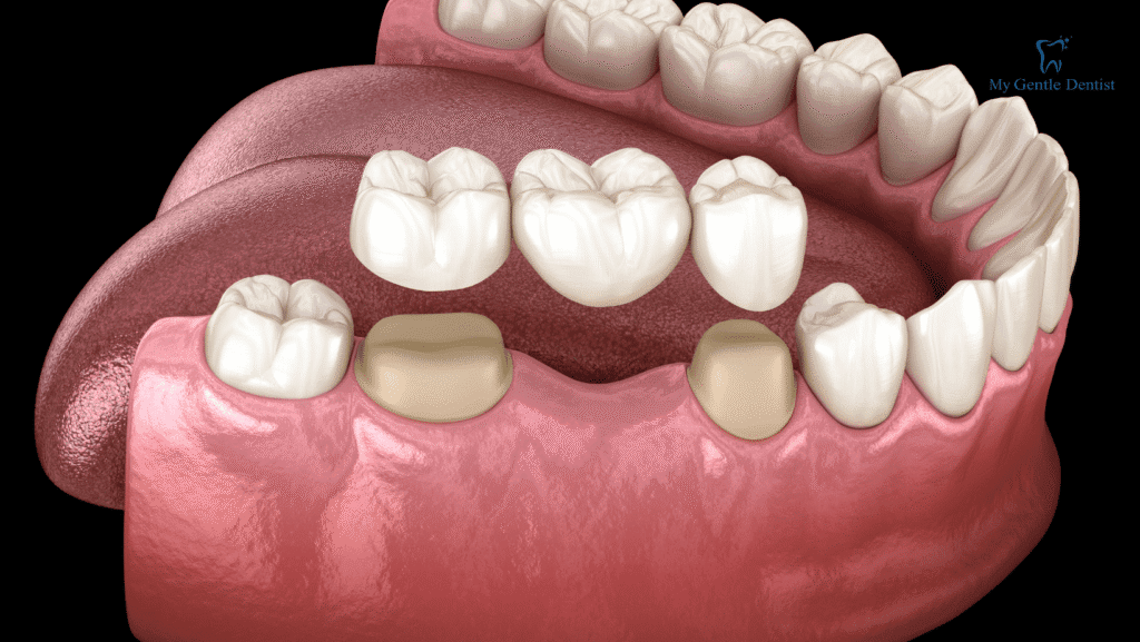 What are Dental Crowns and Bridges?