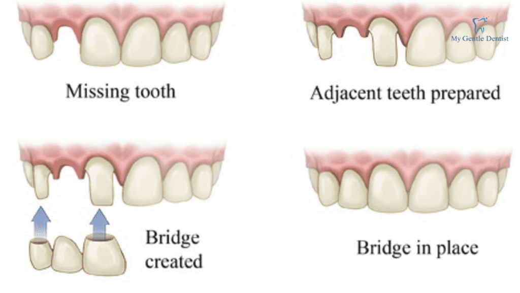 What are Dental Crowns and Bridges?