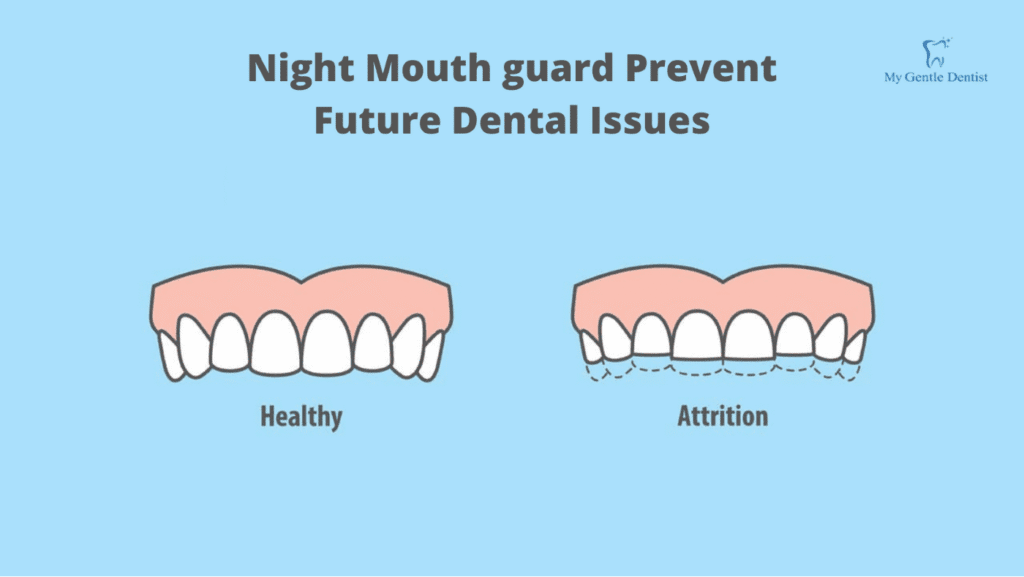Reasons You Should Get a Night Mouth Guard to Protect Your Teeth Reasons You Should Get a Night Mouth Guard to Protect Your Teeth