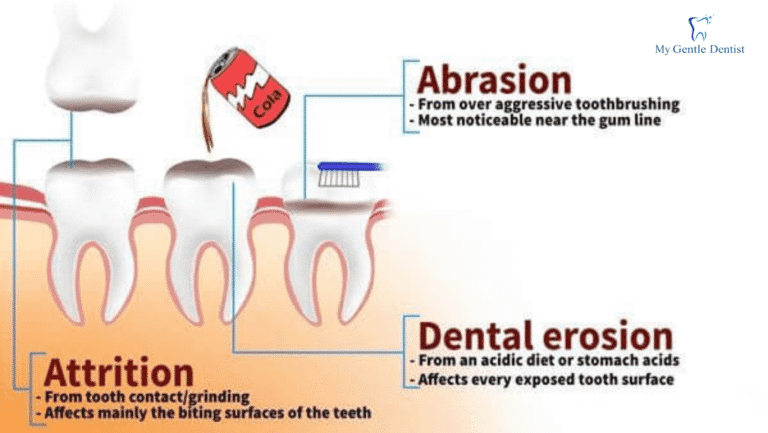 Tooth Wear: Causes, Prevention, and Treatment