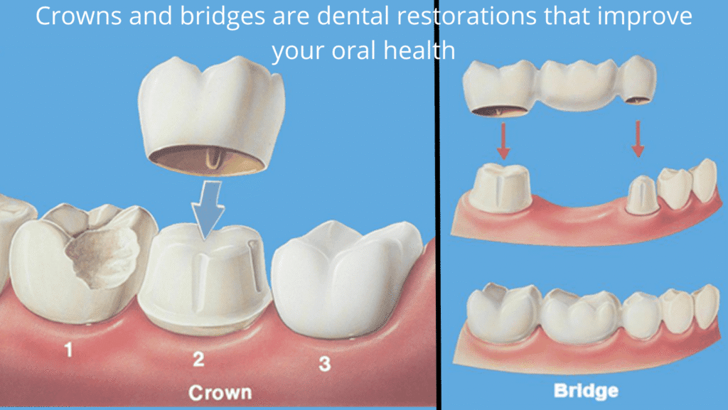 What are Dental Crowns and Bridges? Everything You Need to Know About Them What are Dental Crowns and Bridges? Everything You Need to Know About Them