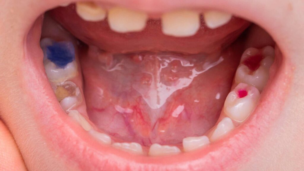 Infections and Abscesses
