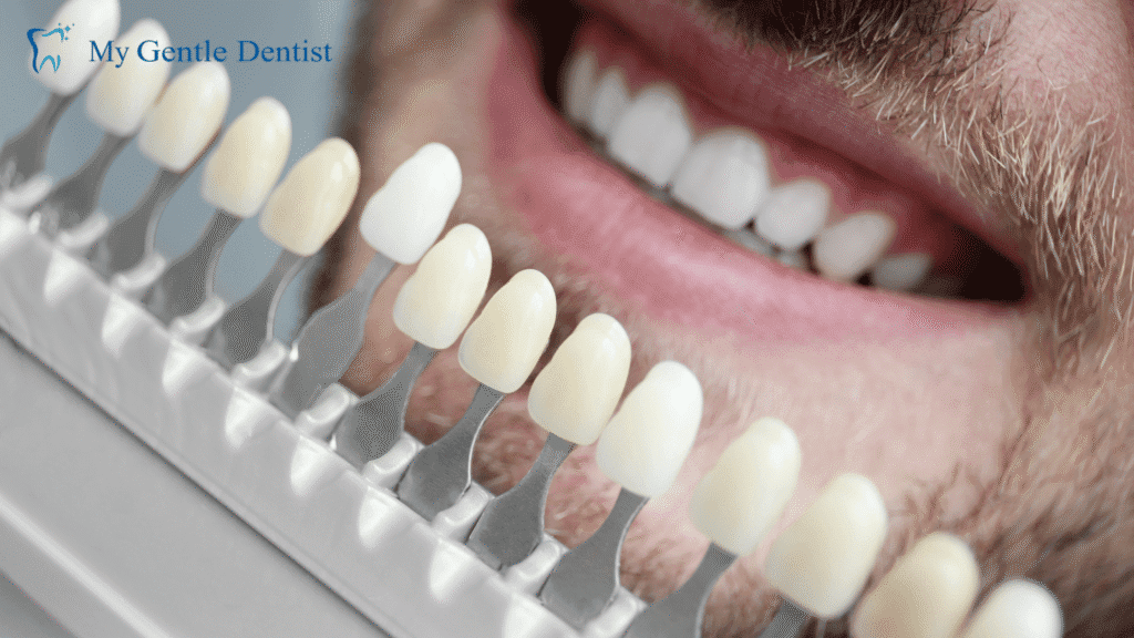 Dental Veneers Explained: Removal, Replacement Options, and Durability Dental veneers