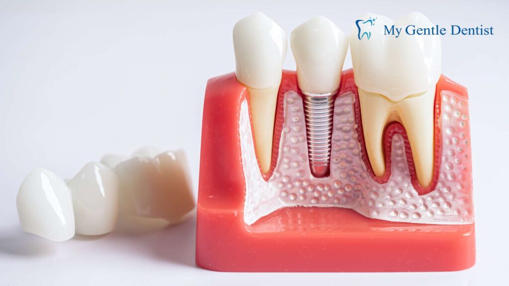 How Much Do Dental Implants Cost in Brisbane? How Much Do Dental Implants Cost in Brisbane?