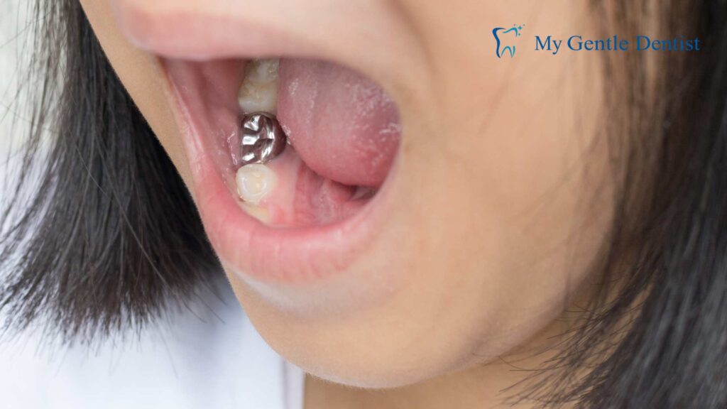 The Benefits of Dental Sealants: Protecting Your Teeth from Tooth Decay Dental Sealants