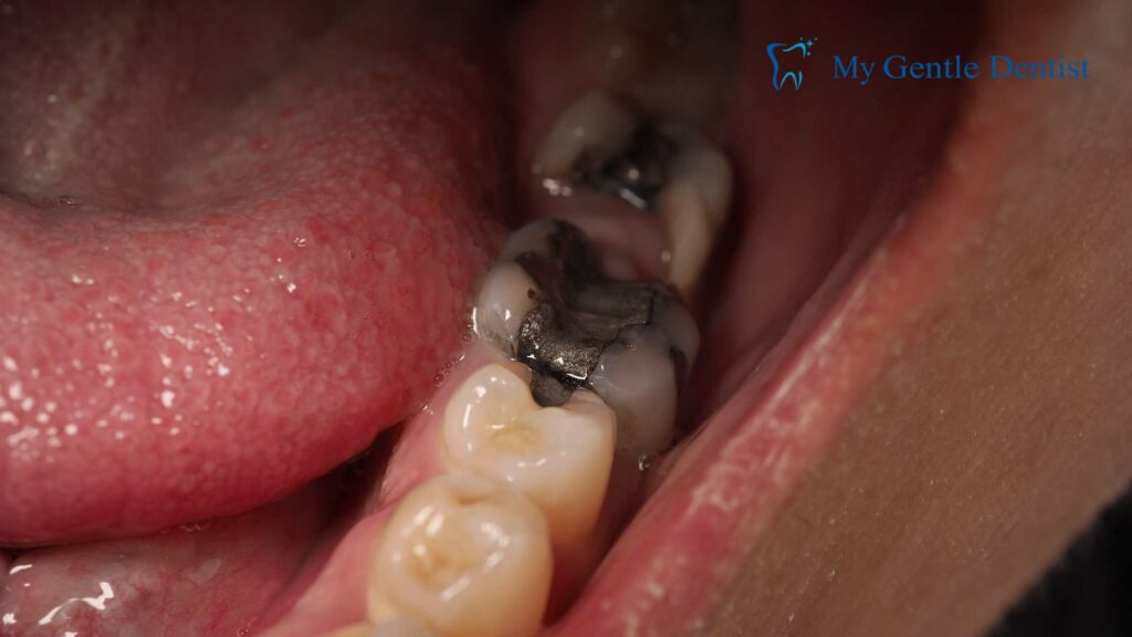 The Benefits of Dental Sealants: Protecting Your Teeth from Tooth Decay Tooth Decay