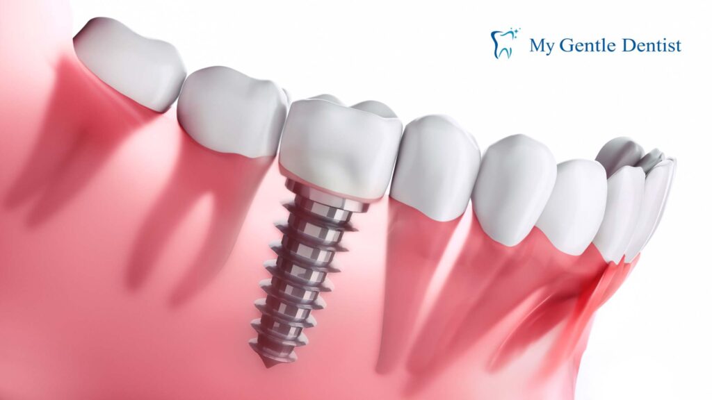 Dental Implants 