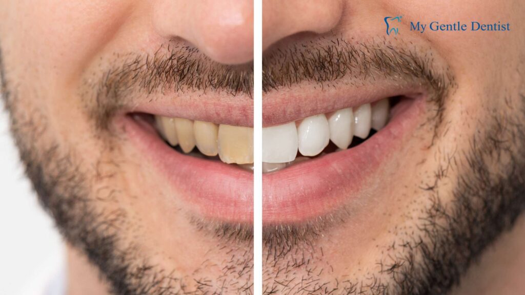 Transform Your Smile Today: Find the Best Cosmetic Dentist Near Me Teeth Whitening