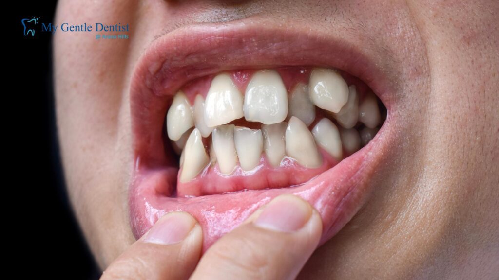 Porcelain Veneers for Crooked Teeth: Are They a Good Option? Porcelain Veneers for Crooked Teeth: Are They a Good Option?