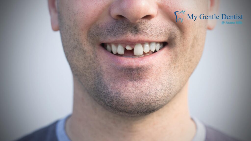 What Emergency Dentists Do When a Tooth Gets Knocked Out knocked-out tooth