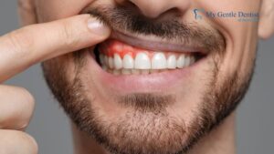 Why Periodontists Near Me Recommend Early Gum Disease Treatment Gum Disease