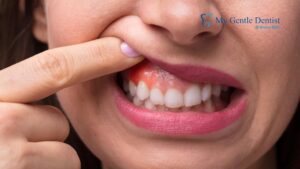 Swollen Gums at Midnight? Your Guide to 'Emergency Dentist Near Me' Swollen Gums