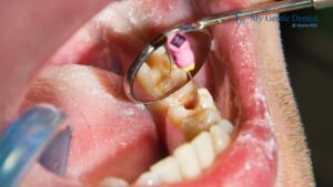 Root Canal