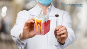 Root Canal Process