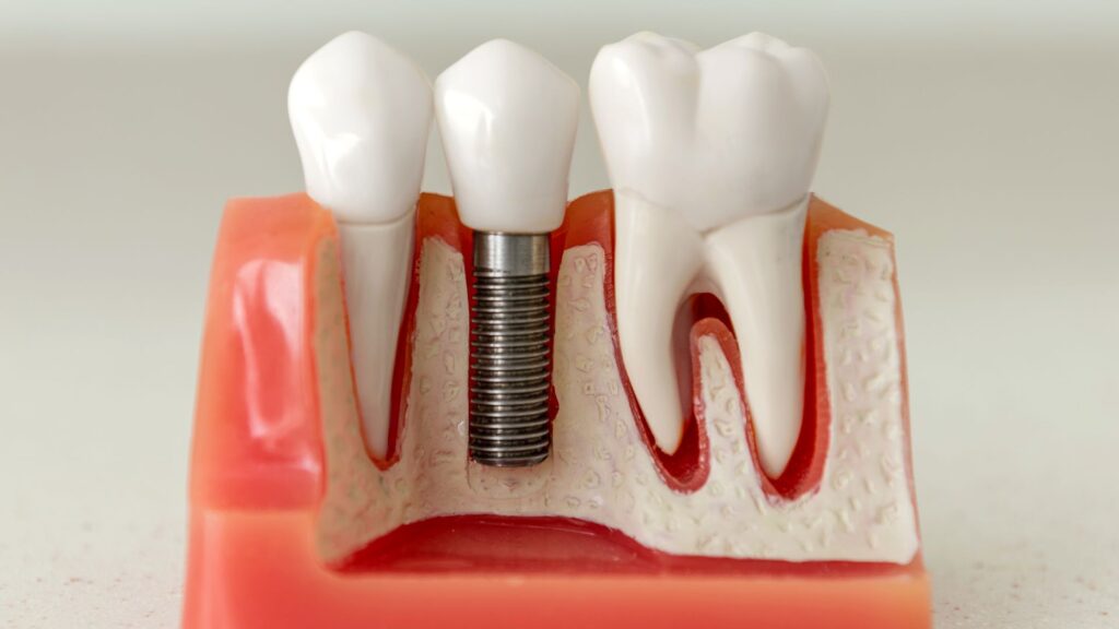 Dental Implants Dental Implants