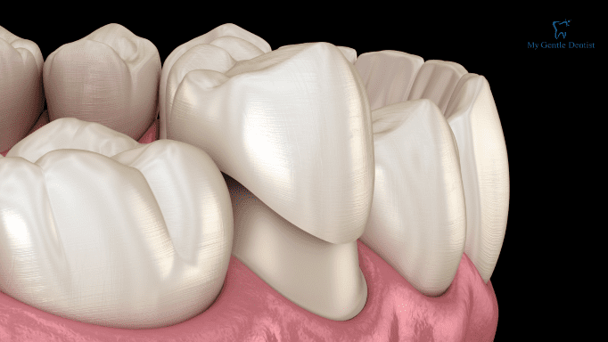 What are Dental Crowns and Bridges? Everything You Need to Know About Them What are Dental Crowns and Bridges? Everything You Need to Know About Them