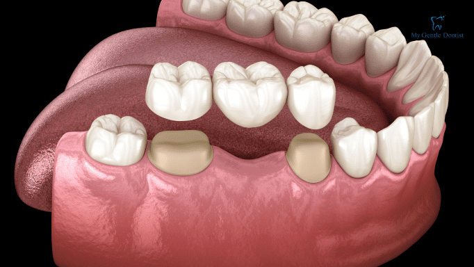 What are Dental Crowns and Bridges? Everything You Need to Know About Them What are Dental Crowns and Bridges? Everything You Need to Know About Them