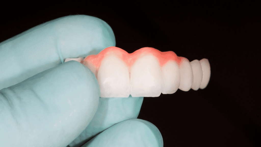 5 Benefits of Dental Bridges – My Gentle Dentist missing teeth