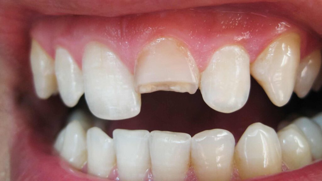 Broken or Cracked Teeth