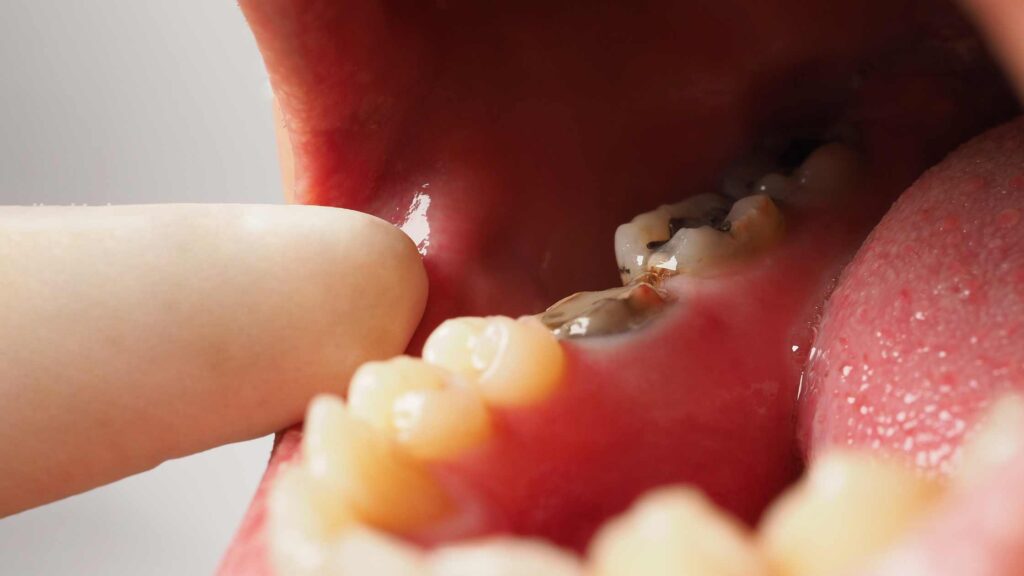 Lost Fillings or Crowns