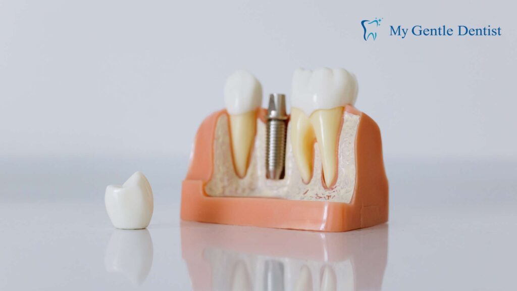 How Much Do Dental Implants Cost in Brisbane? How Much Do Dental Implants Cost in Brisbane?
