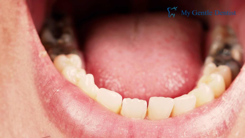 Top 5 Reasons to Choose a Dental Crown for Damaged Teeth Dental treatment