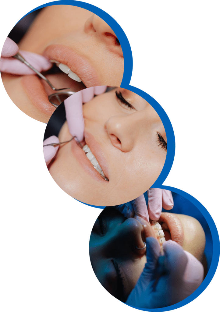 Dental Fillings