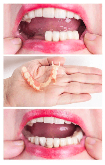 Partial Dentures
