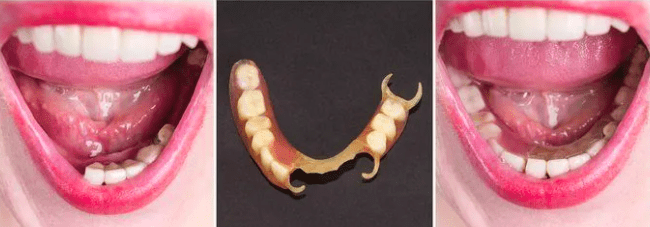 Complete/Partial Dentures
