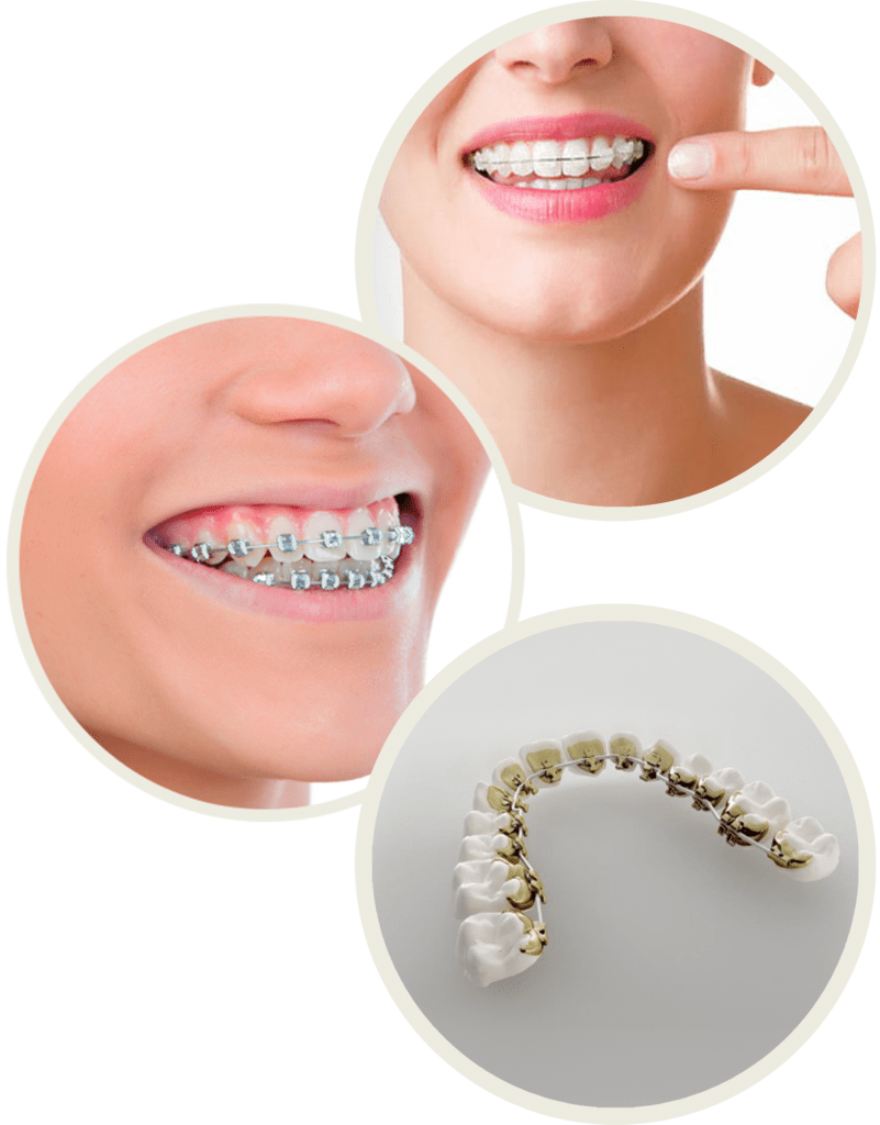 Braces Orthodontic Treatment