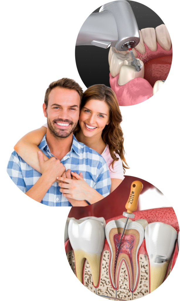 Root Canal Treatment