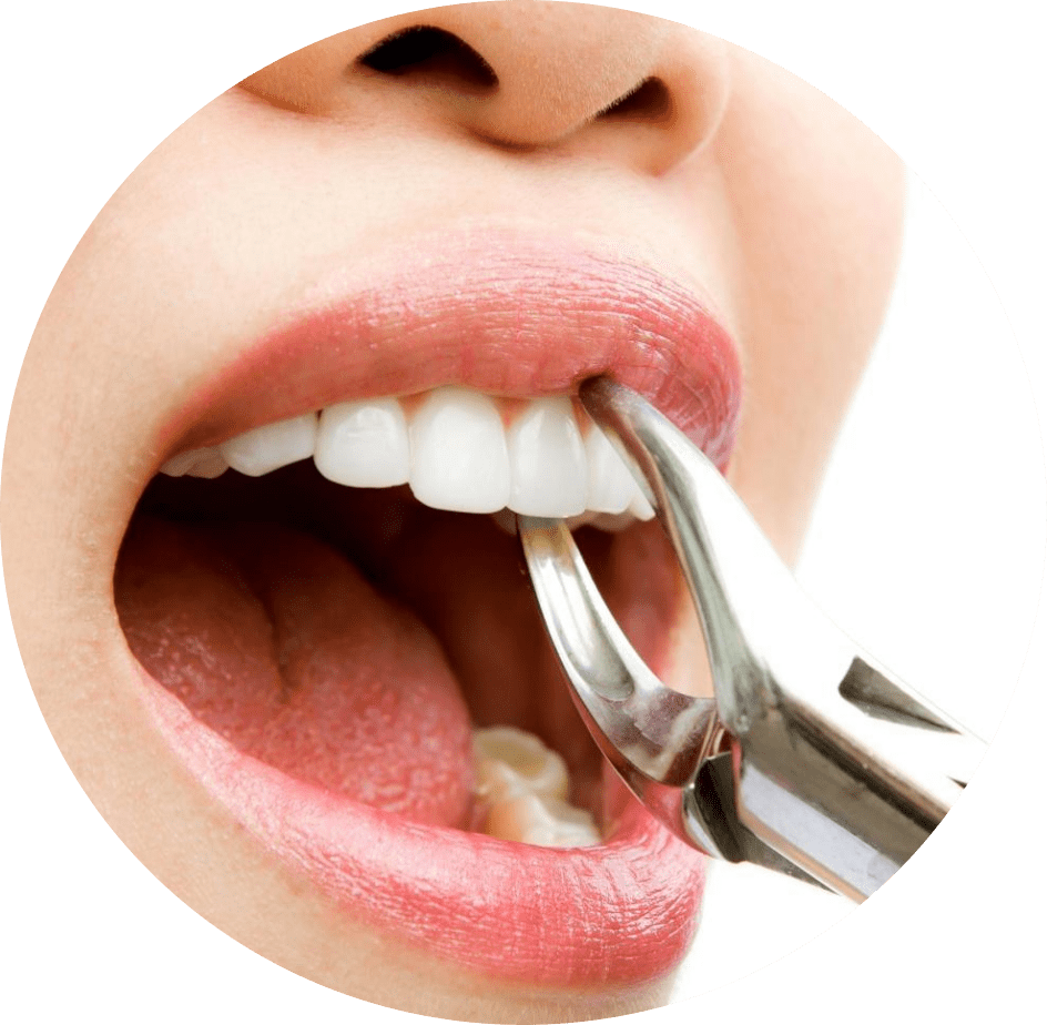 Tooth Extraction