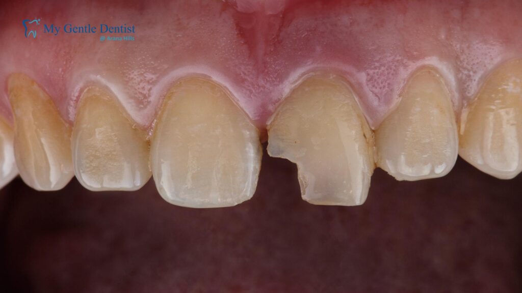 Porcelain Veneers for Crooked Teeth: Are They a Good Option? Chipped Teeth