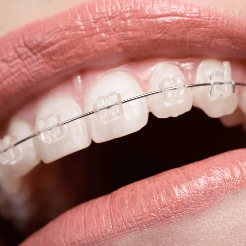 Braces Orthodontic Treatment