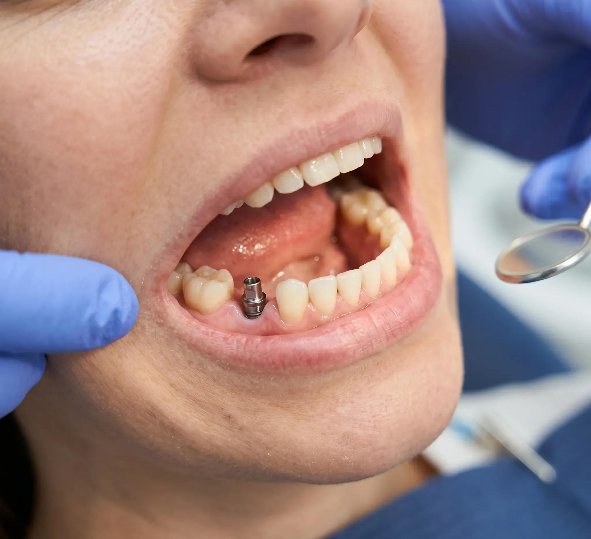 Fixed Teeth on Implants Fixed Teeth on Implants