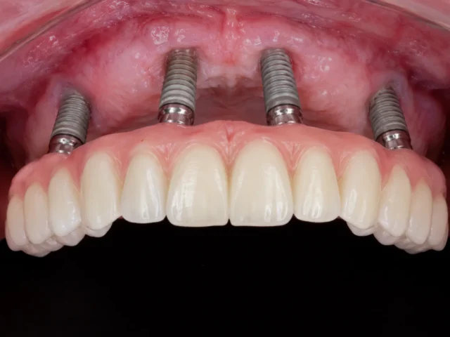 Multiple Implant Multiple Implant