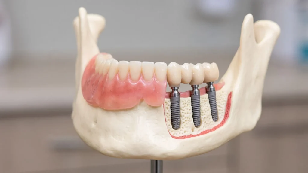 Full Mouth Dental Implants in Brisbane: Is All-On-4 Right For You? Dental Implants in Brisbane